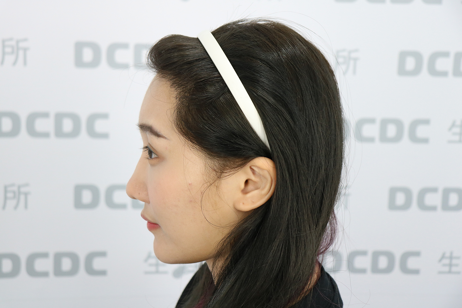 DCDC植髮診所-女性髮際線美型植髮術後側面飽滿線條